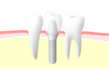 インプラント